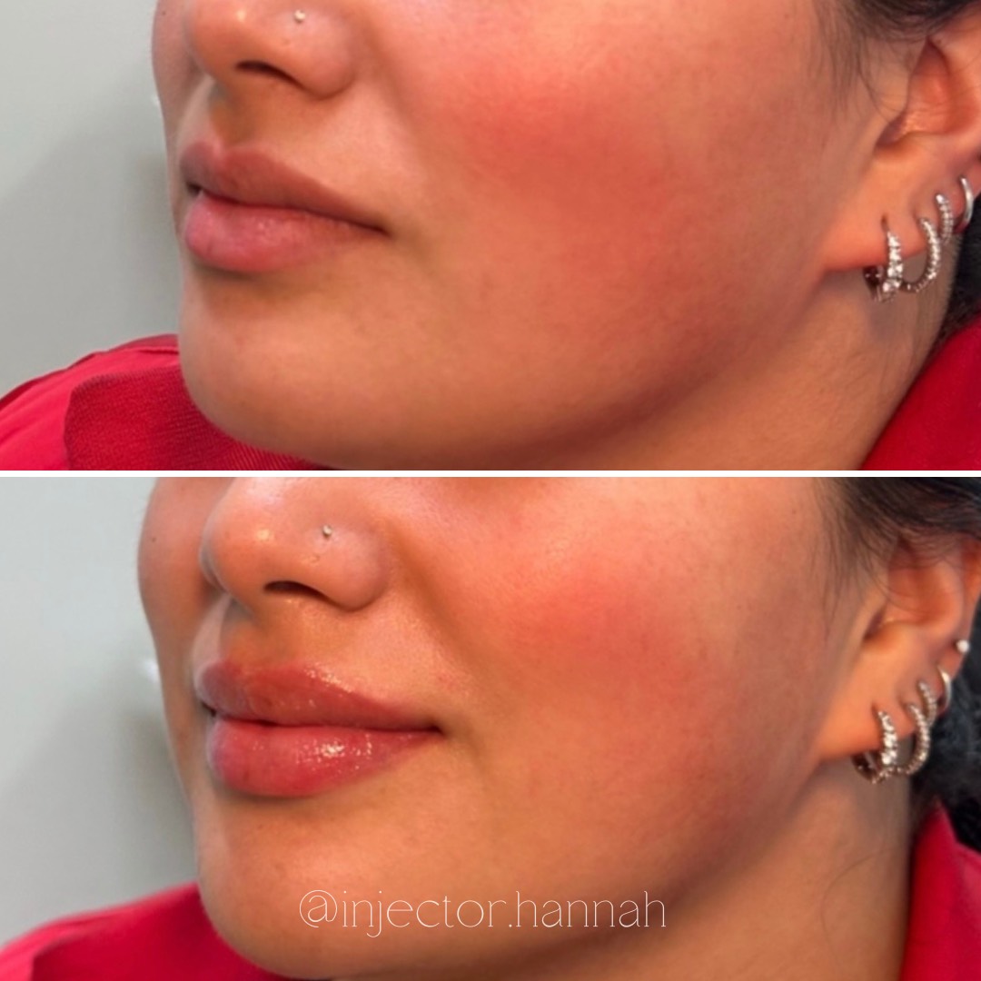 Forehead lines before/after – smoother after 2 weeks